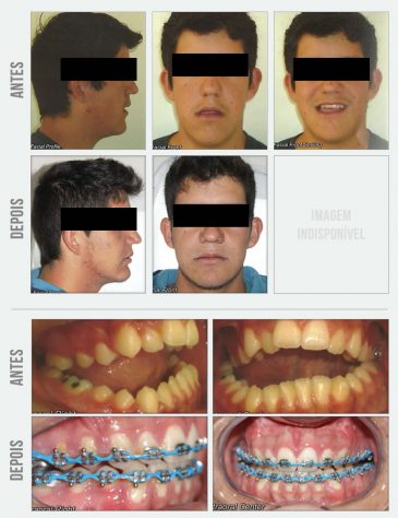 caso mordida aberta